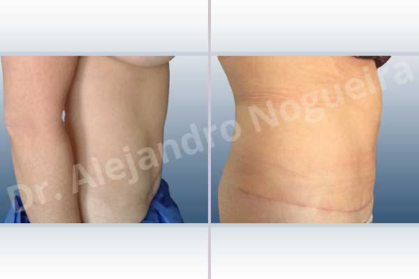 Displaced malpositioned scars,Failed tummy tuck,Hypertrophic scars,Keloid scars,Sunken scars,Wide scars,Excisional scar revision,Fleur de lis abdominoplasty - photo 5