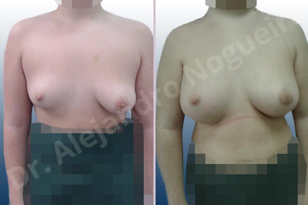 Asymmetric breasts,Empty breasts,Lateral breasts,Moderately saggy droopy breasts,Small breasts,Too far apart wide cleavage breasts,Tuberous breasts,Wide breasts,Anatomical shape,Inframammary incision,Lower hemi periareolar incision,Subfascial pocket plane,Tuberous mammoplasty - photo 1