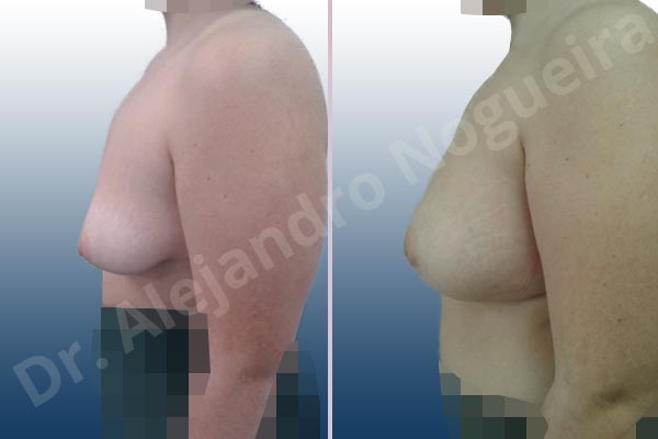 Asymmetric breasts,Empty breasts,Lateral breasts,Moderately saggy droopy breasts,Small breasts,Too far apart wide cleavage breasts,Tuberous breasts,Wide breasts,Anatomical shape,Inframammary incision,Lower hemi periareolar incision,Subfascial pocket plane,Tuberous mammoplasty - photo 2