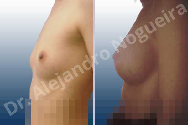 Asymmetric breasts,Cross eyed breasts,Lateral breasts,Narrow breasts,Pigeon chest,Skinny breasts,Small breasts,Anatomical shape,Lower hemi periareolar incision,Subfascial pocket plane - photo 2