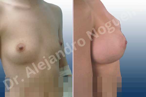 Asymmetric breasts,Cross eyed breasts,Lateral breasts,Narrow breasts,Pigeon chest,Skinny breasts,Small breasts,Anatomical shape,Lower hemi periareolar incision,Subfascial pocket plane - photo 5