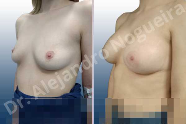 Asymmetric breasts,Empty breasts,Mildly saggy droopy breasts,Slightly saggy droopy breasts,Small breasts,Wide breasts,Anatomical shape,Lower hemi periareolar incision,Subfascial pocket plane - photo 3
