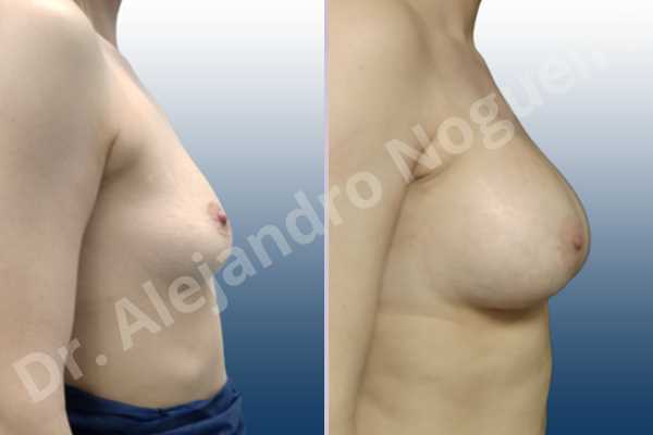 Asymmetric breasts,Empty breasts,Mildly saggy droopy breasts,Slightly saggy droopy breasts,Small breasts,Wide breasts,Anatomical shape,Lower hemi periareolar incision,Subfascial pocket plane - photo 4