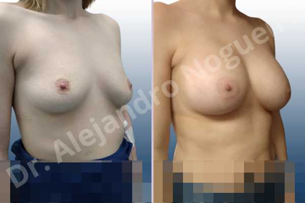 Asymmetric breasts,Empty breasts,Mildly saggy droopy breasts,Slightly saggy droopy breasts,Small breasts,Wide breasts,Anatomical shape,Lower hemi periareolar incision,Subfascial pocket plane - photo 5