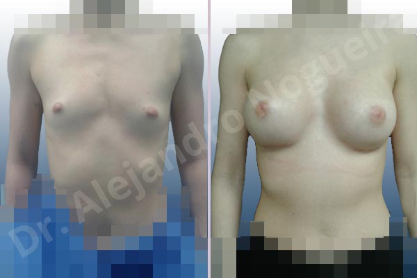 Cleft nipples,Inverted nipples,Lateral breasts,Narrow breasts,Skinny breasts,Small breasts,Sunken chest,Too far apart wide cleavage breasts,Anatomical shape,Inframammary incision,Subfascial pocket plane - photo 1