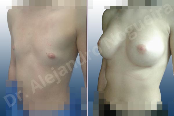 Cleft nipples,Inverted nipples,Lateral breasts,Narrow breasts,Skinny breasts,Small breasts,Sunken chest,Too far apart wide cleavage breasts,Anatomical shape,Inframammary incision,Subfascial pocket plane - photo 3