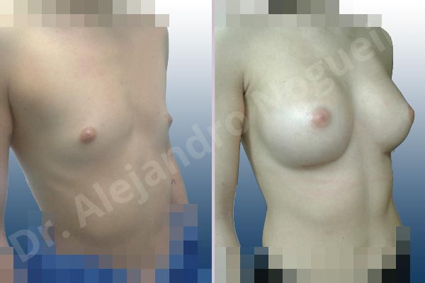 Cleft nipples,Inverted nipples,Lateral breasts,Narrow breasts,Skinny breasts,Small breasts,Sunken chest,Too far apart wide cleavage breasts,Anatomical shape,Inframammary incision,Subfascial pocket plane - photo 5