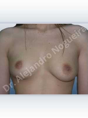 Asymmetric breasts,Empty breasts,Mildly saggy droopy breasts,Moderately saggy droopy breasts,Narrow breasts,Small breasts,Anatomical shape,Lower hemi periareolar incision,Subfascial pocket plane