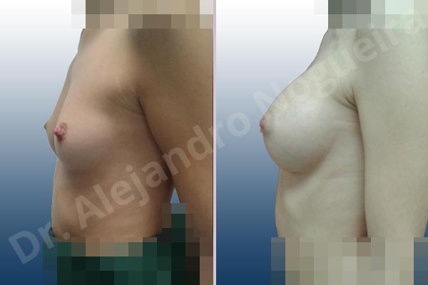 Asymmetric breasts,Lateral breasts,Narrow breasts,Skinny breasts,Small breasts,Too far apart wide cleavage breasts,Anatomical shape,Extra large size,Inframammary incision,Subfascial pocket plane - photo 2