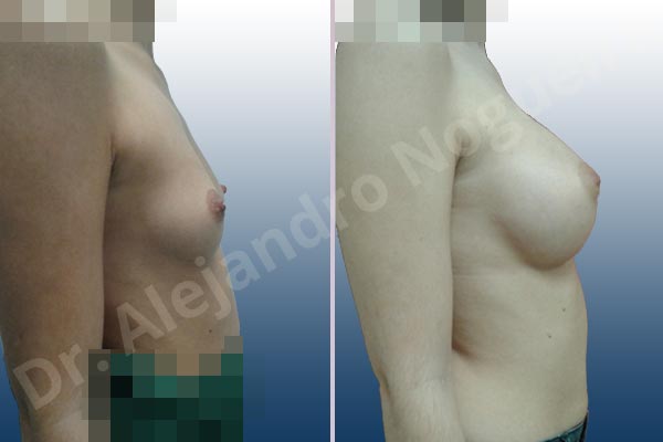Asymmetric breasts,Lateral breasts,Narrow breasts,Skinny breasts,Small breasts,Too far apart wide cleavage breasts,Anatomical shape,Extra large size,Inframammary incision,Subfascial pocket plane - photo 4