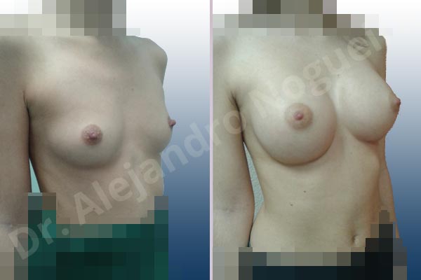 Asymmetric breasts,Lateral breasts,Narrow breasts,Skinny breasts,Small breasts,Too far apart wide cleavage breasts,Anatomical shape,Extra large size,Inframammary incision,Subfascial pocket plane - photo 5