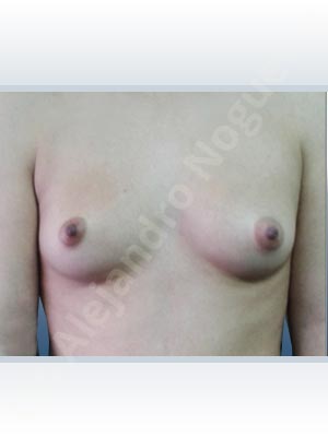 Asymmetric breasts,Cross eyed breasts,Empty breasts,Narrow breasts,Skinny breasts,Small breasts,Inframammary incision,Round shape,Subfascial pocket plane