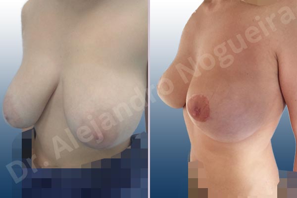 Extremely saggy droopy breasts,Large areolas,Moderately large breasts,Pendulous breasts,Tuberous breasts,Areola reduction,Lollipop incision,Superior pedicle - photo 3