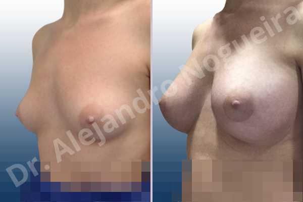 Asymmetric breasts,Empty breasts,Lateral breasts,Small breasts,Sunken chest,Too far apart wide cleavage breasts,Wide breasts,Anatomical shape,Lower hemi periareolar incision,Subfascial pocket plane - photo 3