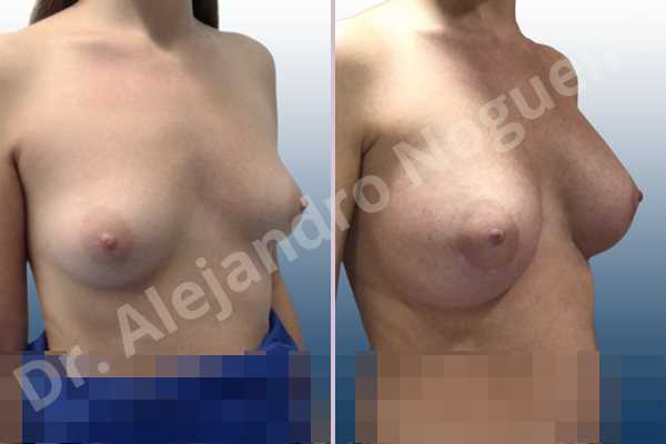 Asymmetric breasts,Empty breasts,Lateral breasts,Small breasts,Sunken chest,Too far apart wide cleavage breasts,Wide breasts,Anatomical shape,Lower hemi periareolar incision,Subfascial pocket plane - photo 5