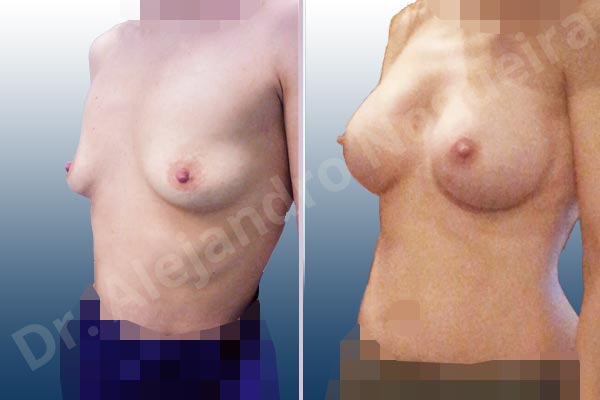 Empty breasts,Lateral breasts,Narrow breasts,Skinny breasts,Slightly saggy droopy breasts,Small breasts,Too far apart wide cleavage breasts,Anatomical shape,Lower hemi periareolar incision,Subfascial pocket plane - photo 3
