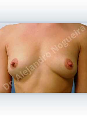 Lateral breasts,Slightly saggy droopy breasts,Small breasts,Wide breasts,Anatomical shape,Extra large size,Lower hemi periareolar incision,Subfascial pocket plane