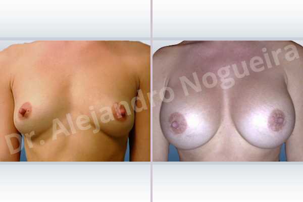 Lateral breasts,Slightly saggy droopy breasts,Small breasts,Wide breasts,Anatomical shape,Extra large size,Lower hemi periareolar incision,Subfascial pocket plane - photo 1