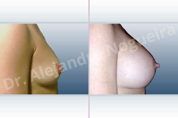 Lateral breasts,Slightly saggy droopy breasts,Small breasts,Wide breasts,Anatomical shape,Extra large size,Lower hemi periareolar incision,Subfascial pocket plane - photo 4
