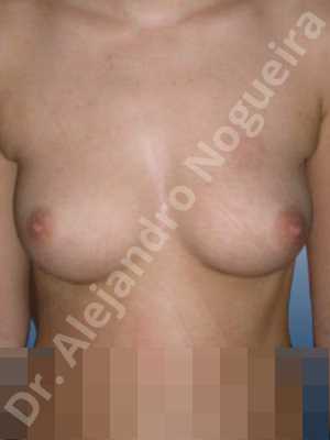 Cross eyed breasts,Small breasts,Anatomical shape,Lower hemi periareolar incision,Subfascial pocket plane