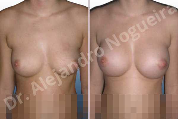 Cross eyed breasts,Small breasts,Anatomical shape,Lower hemi periareolar incision,Subfascial pocket plane - photo 1