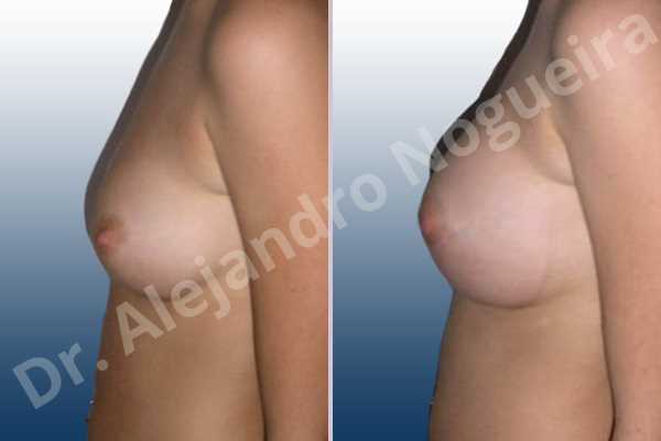 Cross eyed breasts,Small breasts,Anatomical shape,Lower hemi periareolar incision,Subfascial pocket plane - photo 2