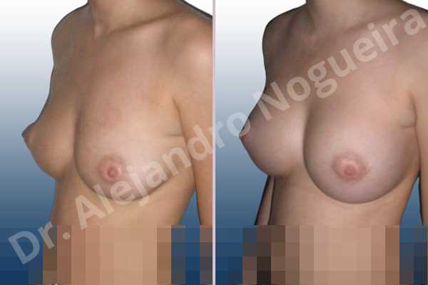Cross eyed breasts,Small breasts,Anatomical shape,Lower hemi periareolar incision,Subfascial pocket plane - photo 3