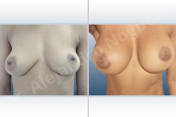 Asymmetric breasts,Cross eyed breasts,Empty breasts,Lateral breasts,Mildly saggy droopy breasts,Small breasts,Too far apart wide cleavage breasts,Anatomical shape,Extra large size,Lower hemi periareolar incision,Subfascial pocket plane - photo 1
