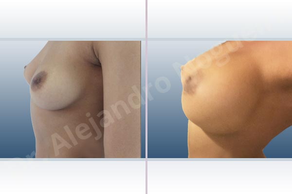 Asymmetric breasts,Cross eyed breasts,Empty breasts,Lateral breasts,Mildly saggy droopy breasts,Small breasts,Too far apart wide cleavage breasts,Anatomical shape,Extra large size,Lower hemi periareolar incision,Subfascial pocket plane - photo 2