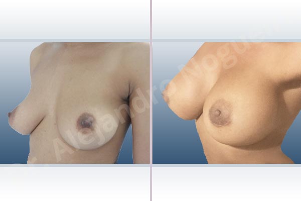 Asymmetric breasts,Cross eyed breasts,Empty breasts,Lateral breasts,Mildly saggy droopy breasts,Small breasts,Too far apart wide cleavage breasts,Anatomical shape,Extra large size,Lower hemi periareolar incision,Subfascial pocket plane - photo 3