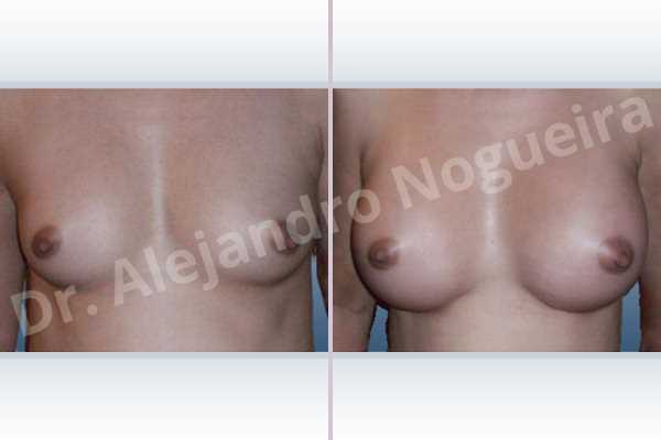 Asymmetric breasts,Narrow breasts,Small breasts,Anatomical shape,Inframammary incision,Subfascial pocket plane - photo 1