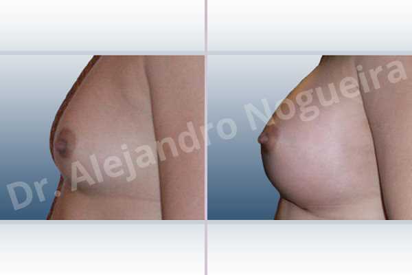 Asymmetric breasts,Narrow breasts,Small breasts,Anatomical shape,Inframammary incision,Subfascial pocket plane - photo 2