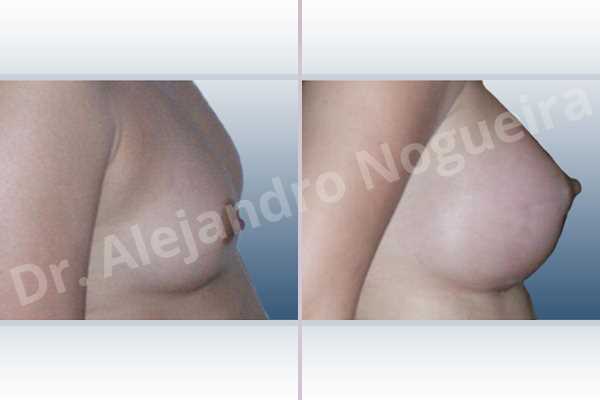 Asymmetric breasts,Narrow breasts,Small breasts,Anatomical shape,Inframammary incision,Subfascial pocket plane - photo 3
