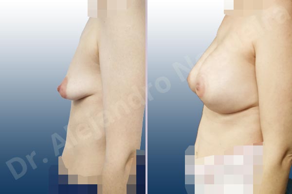 Asymmetric breasts,Empty breasts,Large areolas,Lateral breasts,Mildly saggy droopy breasts,Moderately saggy droopy breasts,Narrow breasts,Pendulous breasts,Skinny breasts,Small breasts,Sunken chest,Too far apart wide cleavage breasts,Tuberous breasts,Anatomical shape,Areola reduction,Circumareolar incision,Subfascial pocket plane,Tuberous mammoplasty - photo 2
