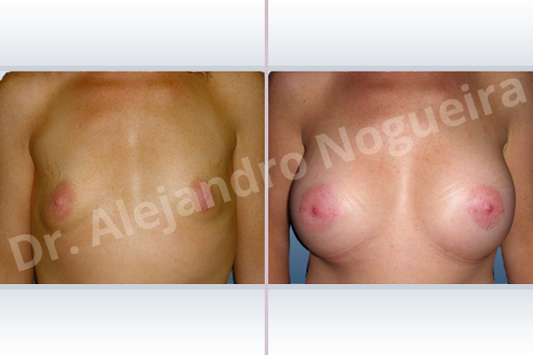 Asymmetric breasts,Empty breasts,Large areolas,Lateral breasts,Narrow breasts,Pigeon chest,Skinny breasts,Slightly saggy droopy breasts,Small breasts,Too far apart wide cleavage breasts,Tuberous breasts,Lower hemi periareolar incision,Round shape,Subfascial pocket plane - photo 1