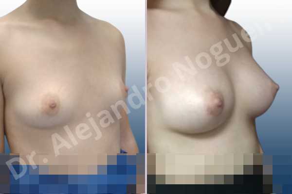 Asymmetric breasts,Empty breasts,Lateral breasts,Small breasts,Too far apart wide cleavage breasts,Anatomical shape,Lower hemi periareolar incision,Subfascial pocket plane - photo 5
