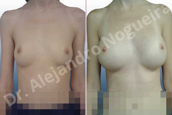 Small breasts,Lateral breasts,Too far apart wide cleavage breasts,Pigeon chest,Skinny breasts,Anatomical shape,Extra large size,Inframammary incision,Subfascial pocket plane - photo 1