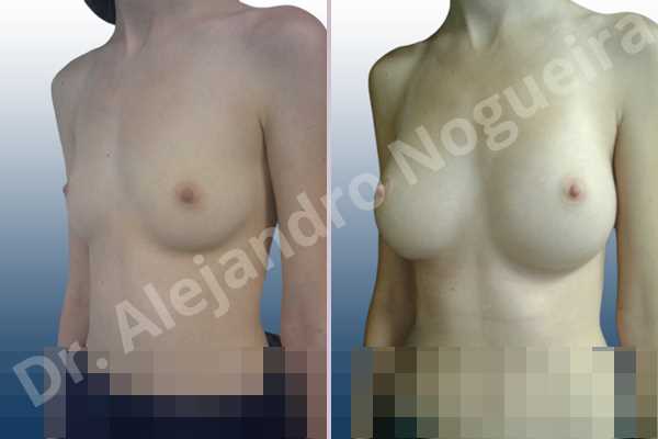Small breasts,Lateral breasts,Too far apart wide cleavage breasts,Pigeon chest,Skinny breasts,Anatomical shape,Extra large size,Inframammary incision,Subfascial pocket plane - photo 3