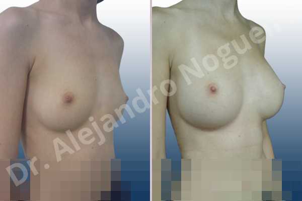 Small breasts,Lateral breasts,Too far apart wide cleavage breasts,Pigeon chest,Skinny breasts,Anatomical shape,Extra large size,Inframammary incision,Subfascial pocket plane - photo 5