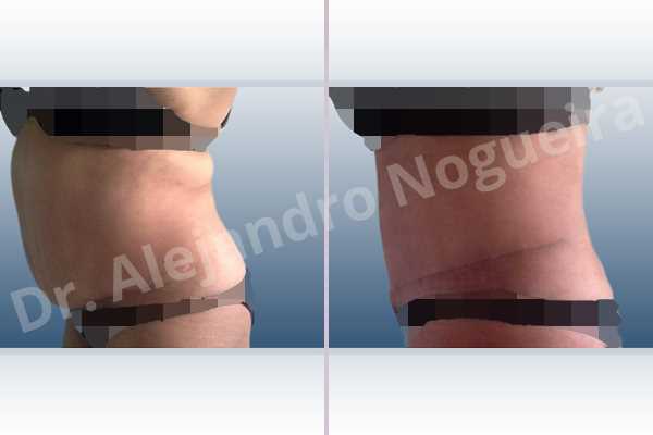 Displaced malpositioned scars,Failed tummy tuck,Saggy abdomen,Weak abdomen muscles,Excisional scar revision,Panniculectomy,Standard abdominoplasty - photo 2