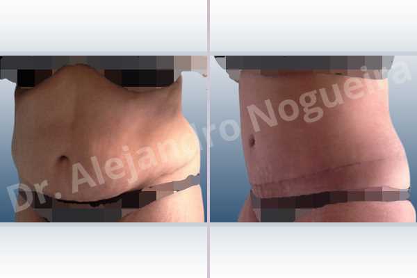Displaced malpositioned scars,Failed tummy tuck,Saggy abdomen,Weak abdomen muscles,Excisional scar revision,Panniculectomy,Standard abdominoplasty - photo 3
