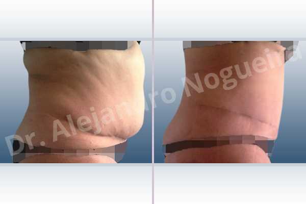 Displaced malpositioned scars,Failed tummy tuck,Saggy abdomen,Weak abdomen muscles,Excisional scar revision,Panniculectomy,Standard abdominoplasty - photo 4