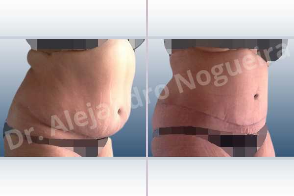 Displaced malpositioned scars,Failed tummy tuck,Saggy abdomen,Weak abdomen muscles,Excisional scar revision,Panniculectomy,Standard abdominoplasty - photo 5
