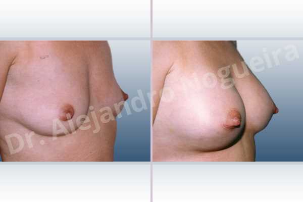 Empty breasts,Slightly saggy droopy breasts,Small breasts,Lower hemi periareolar incision,Round shape,Subfascial pocket plane - photo 2