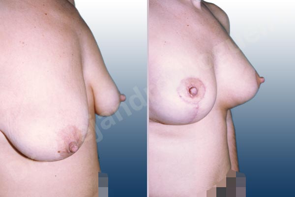 Empty breasts,Severely saggy droopy breasts,Too far apart wide cleavage breasts,Anatomical shape,Lollipop incision,Subfascial pocket plane,Superior pedicle - photo 2