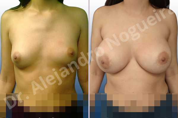 Asymmetric breasts,Empty breasts,Lateral breasts,Skinny breasts,Small breasts,Too far apart wide cleavage breasts,Extra large size,Lower hemi periareolar incision,Round shape,Dual plane pocket - photo 1