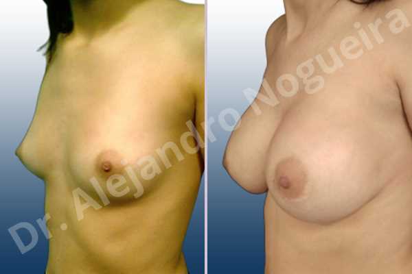 Asymmetric breasts,Empty breasts,Lateral breasts,Skinny breasts,Small breasts,Too far apart wide cleavage breasts,Extra large size,Lower hemi periareolar incision,Round shape,Dual plane pocket - photo 3