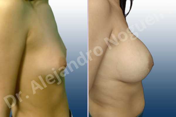 Asymmetric breasts,Empty breasts,Lateral breasts,Skinny breasts,Small breasts,Too far apart wide cleavage breasts,Extra large size,Lower hemi periareolar incision,Round shape,Dual plane pocket - photo 4