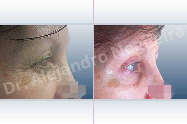 Baggy lower eyelids,Saggy upper eyelids,Upper eyelids ptosis,Lower eyelid fat bags resection,Transconjunctival approach incision,Upper eyelid skin and muscle resection - photo 4