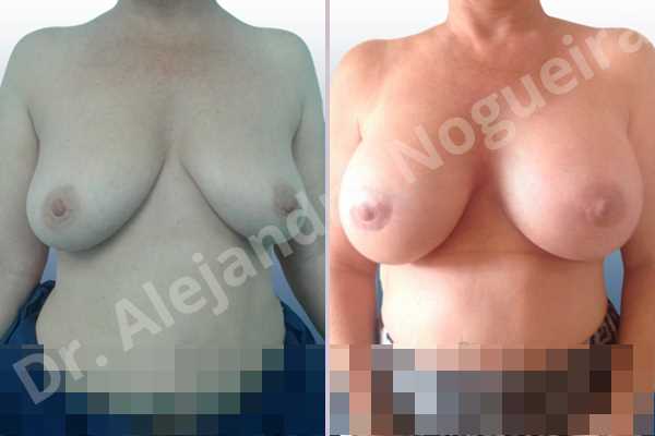 Empty breasts,Lateral breasts,Mildly large breasts,Moderately saggy droopy breasts,Slightly large breasts,Too far apart wide cleavage breasts,Wide breasts,Anatomical shape,Extra large size,Lower hemi periareolar incision,Subfascial pocket plane - photo 1
